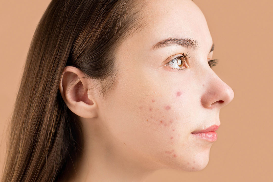 skin-disorder