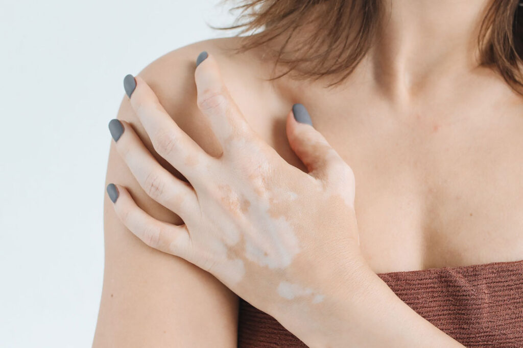 skin-disorder